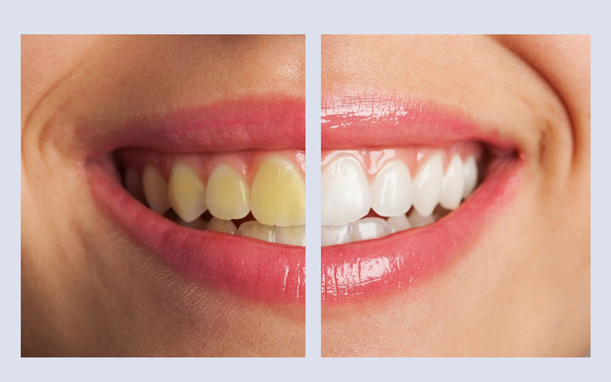 Teeth Whitening Before and After: Real People, Real Results