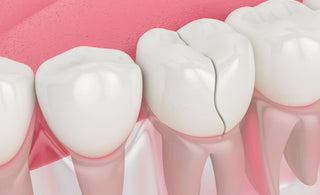 How to Fix a Cracked Tooth Naturally?