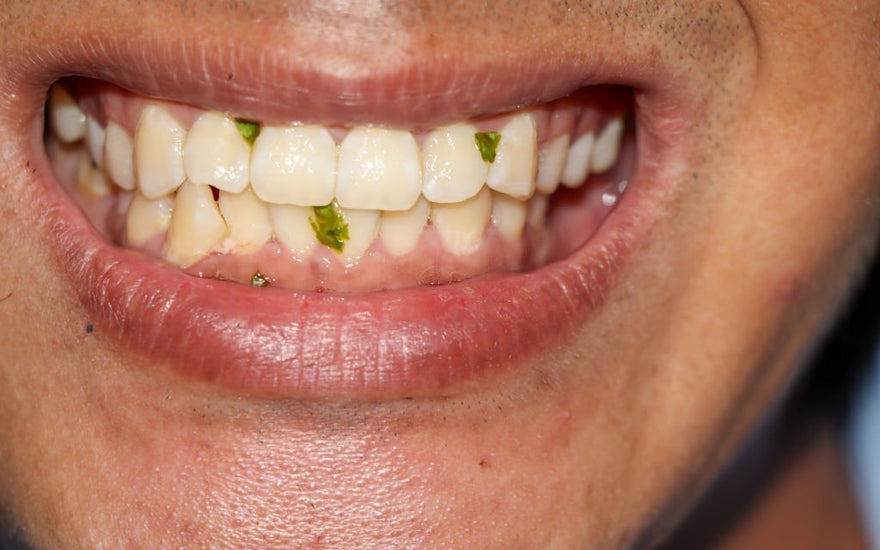 Why Does Food Get Stuck in Your Teeth? 