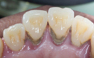 How Long Can You Keep Your Teeth with Periodontal Disease