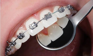 Why Effective Oral Care is Crucial for Braces Wearers: A Comprehensive Guide