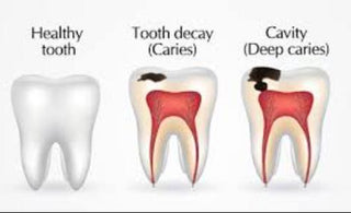 Understanding Caries: Prevention, Symptoms, and Treatment