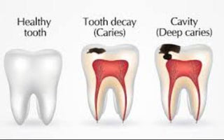 Understanding Caries: Prevention, Symptoms, and Treatment