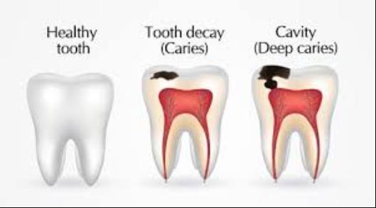 Understanding Caries: Prevention, Symptoms, and Treatment