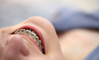 7 Reasons Why Your Dental Braces Are Still On